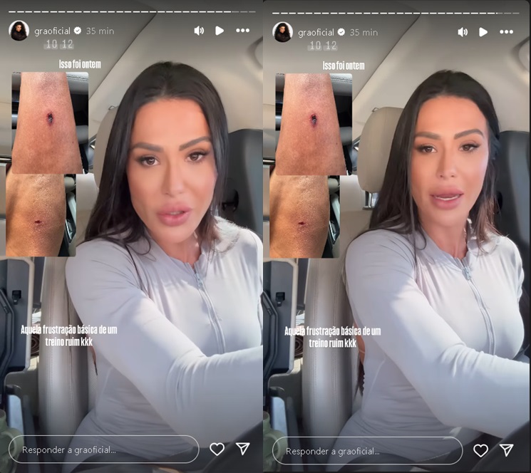 Gracyanne Barbosa sofre acidente e mostra fotos pelo Instagram (Foto: Reprodução)