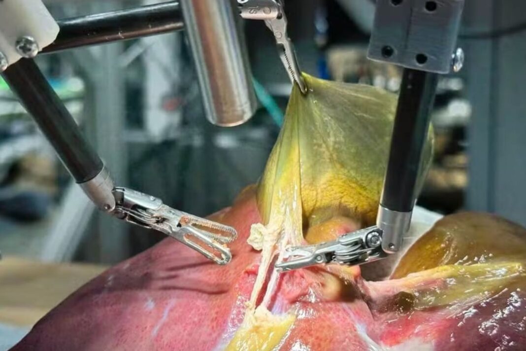 Pela 1ª vez na história da medicina, robô faz cirurgia guiada por IA sem ajuda de humano